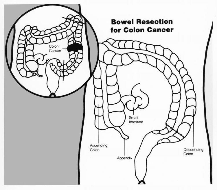 Bowel resection