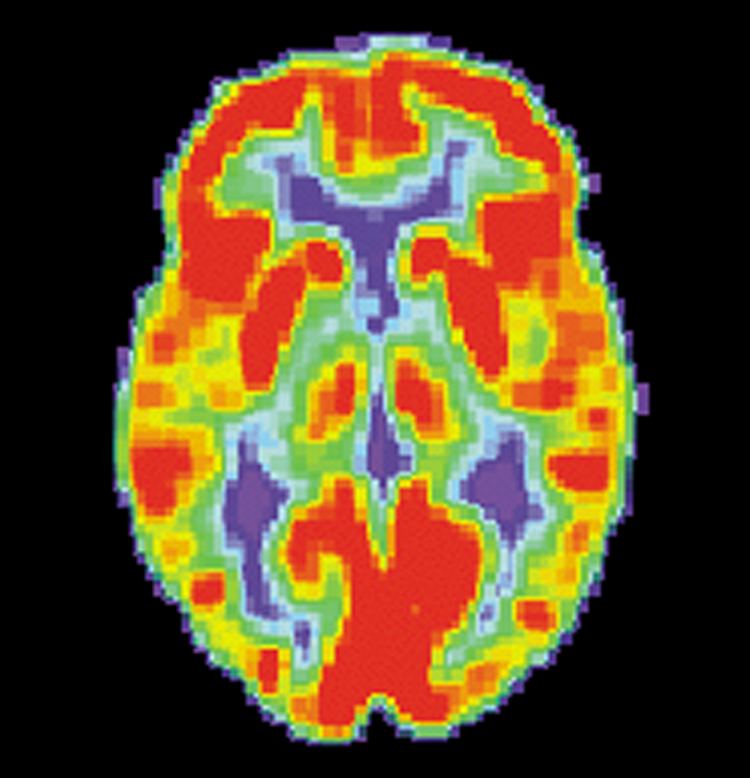 Brain positron emission tomography