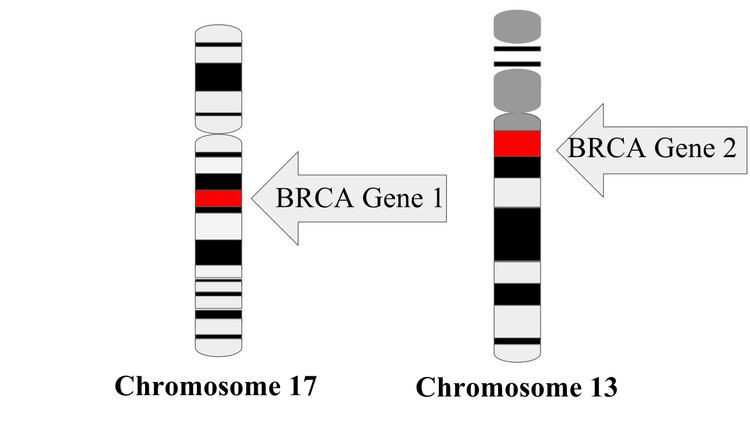 BRCA mutation