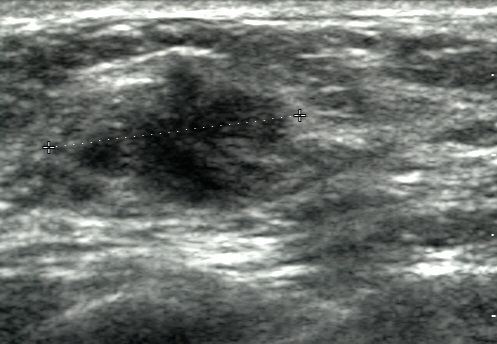 Breast ultrasound