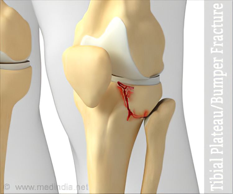 Tibial Plateau | Bumper Fracture - Symptoms, Causes, Treatment, Diagnosis