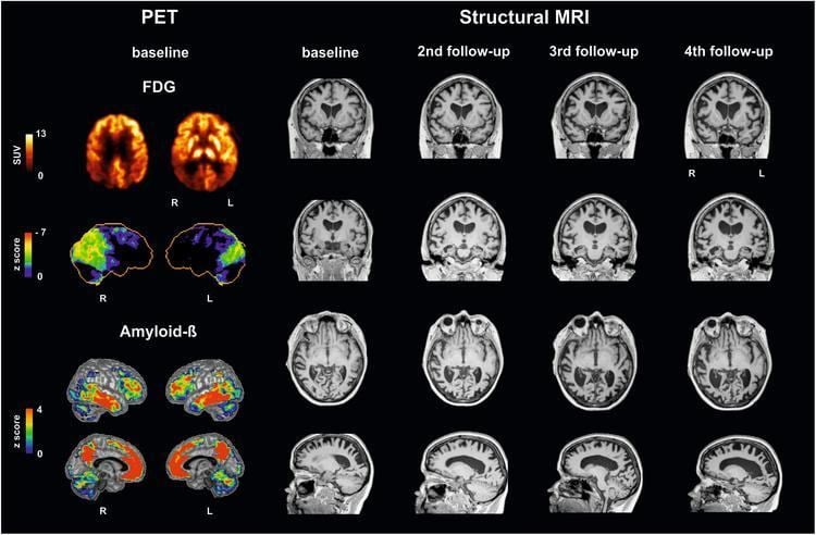 Frontiers | Capgras Delusion in Posterior Cortical Atrophy–A Quantitative  Multimodal Imaging Single Case Study