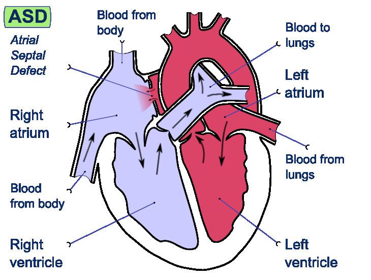 Cardiac shunt