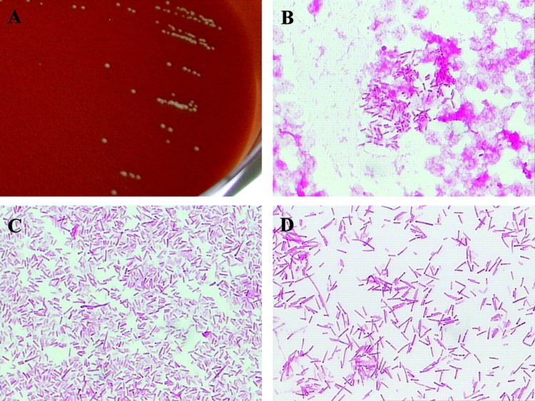 Cardiobacterium hominis Fatal Bioprosthetic Aortic Valve Endocarditis Due to Cardiobacterium