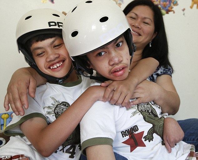 Carl and Clarence Aguirre Formerly conjoined twins Carl and Clarence Aguirre