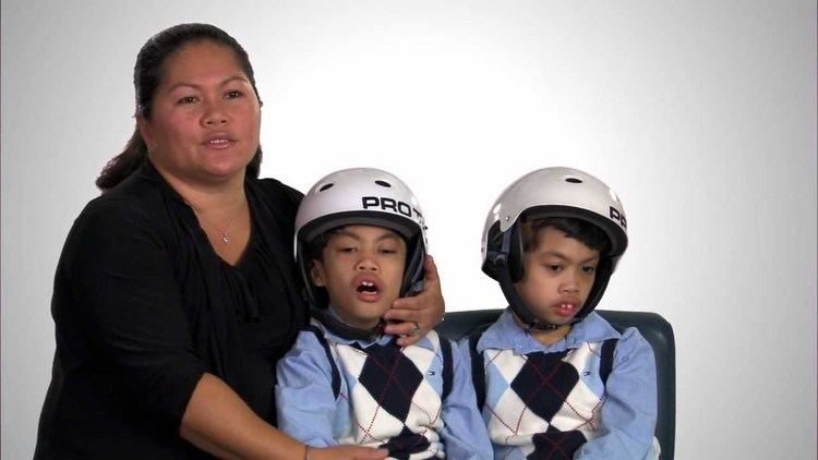 Carl and Clarence Aguirre Conjoined Twins The Aquirre Twins Patient Story YouTube