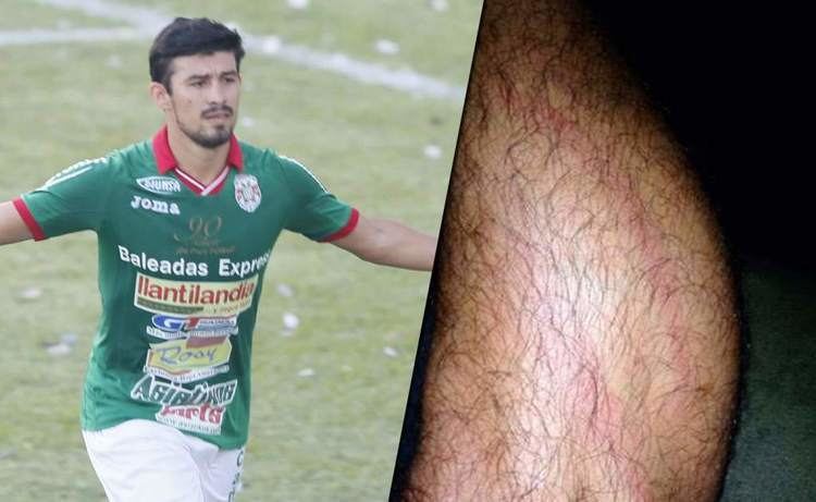 Carlos Will Mejía Rambo Rodrguez muestra cmo le qued la pierna tras el quotcarioquot de