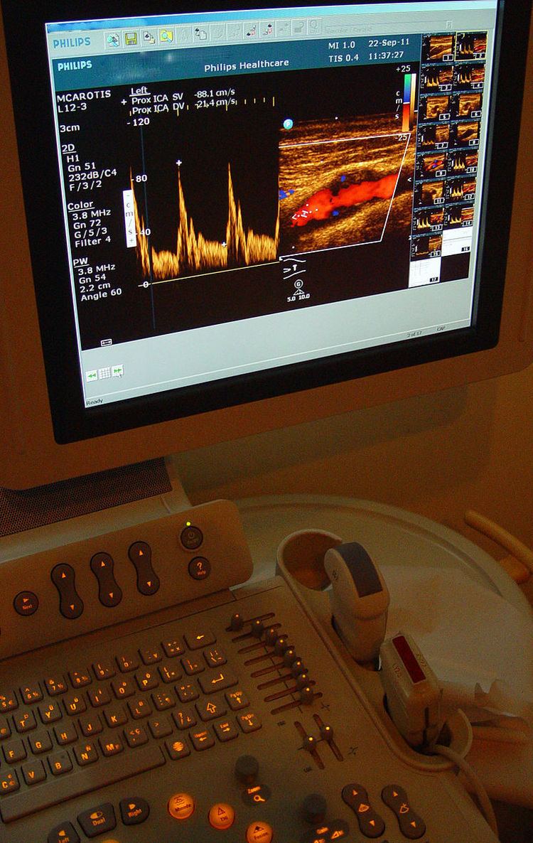 Carotid ultrasonography