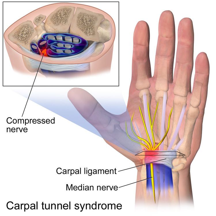 Carpal tunnel surgery