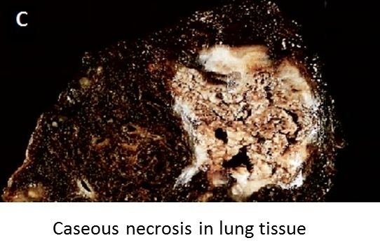 Caseous necrosis