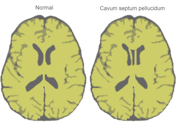 Cave of septum pellucidum