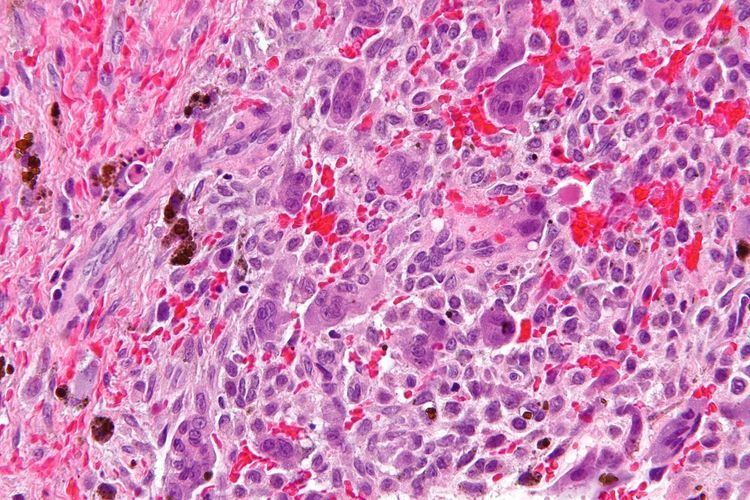 Central giant cell granuloma - Alchetron, the free social encyclopedia