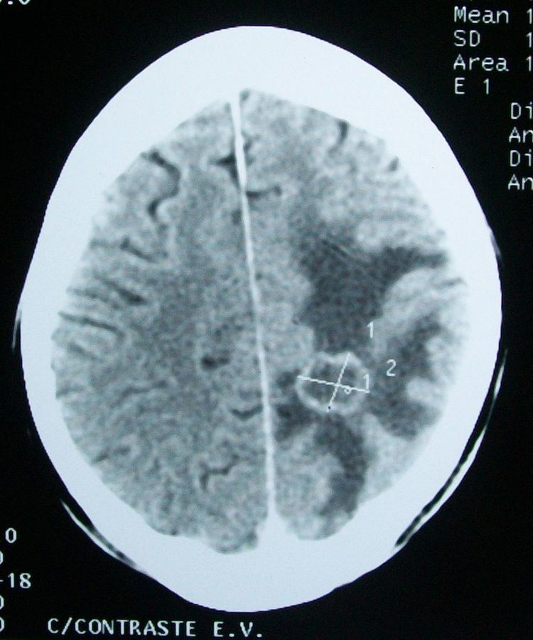 Cerebral edema