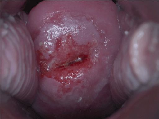 Cervical intraepithelial neoplasia