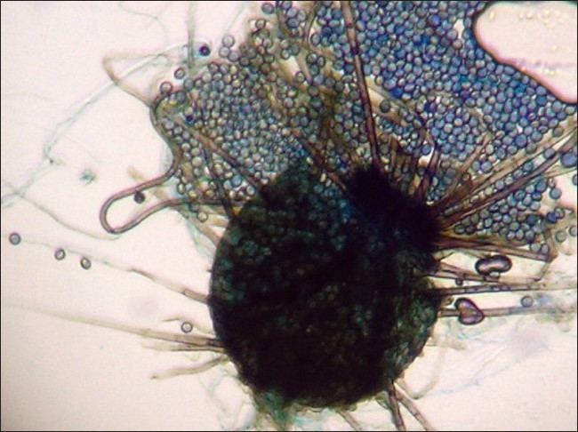 Chaetomium globosum Onychomycosis due to ascomycete Chaetomium globosum A case report