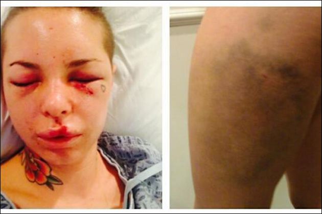 On the left, Christy Mack lying on the bed with a black eye, bruises on her face, and a tattoo on her neck while wearing a white and blue blouse. On the right, Christy's leg with bruises