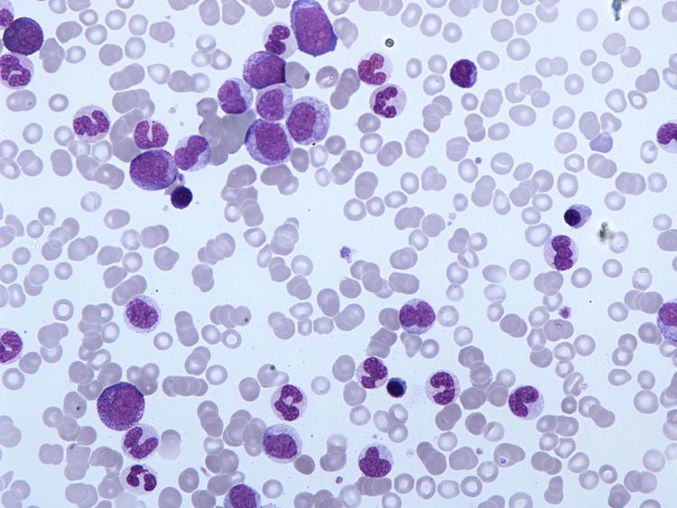 Chronic myelomonocytic leukemia