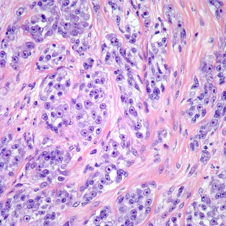 Clear-cell sarcoma