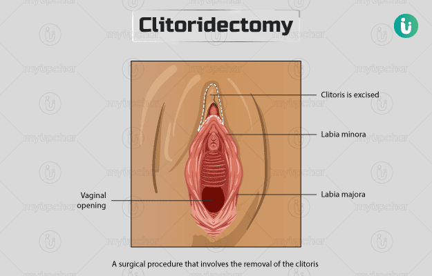 Clitorectomy After