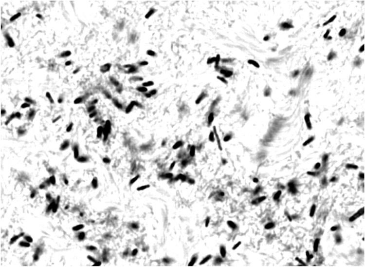 Clostridium septicum Clostridium septicum Myonecrosis in Congenital Neutropenia