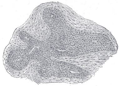 Coccygeal glomus
