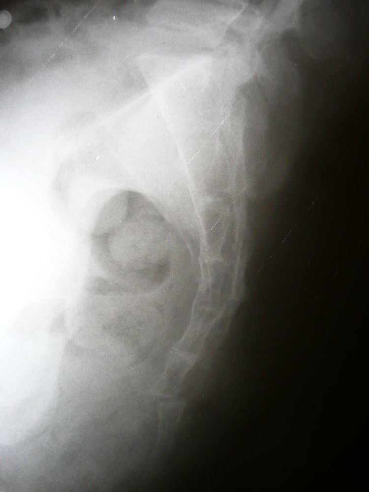 Coccyx fracture