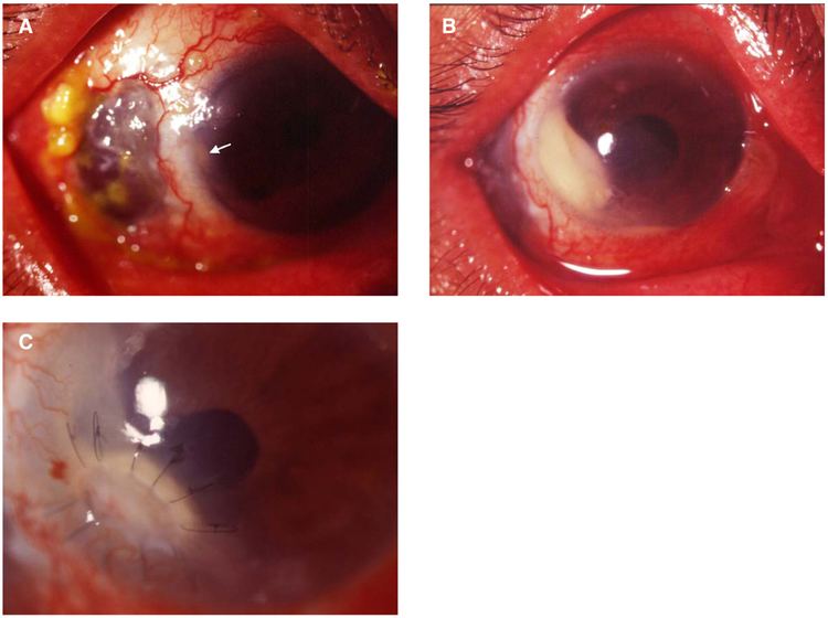 Comamonas acidovorans Experience of Comamonas Acidovorans Keratitis with Delayed Onset and