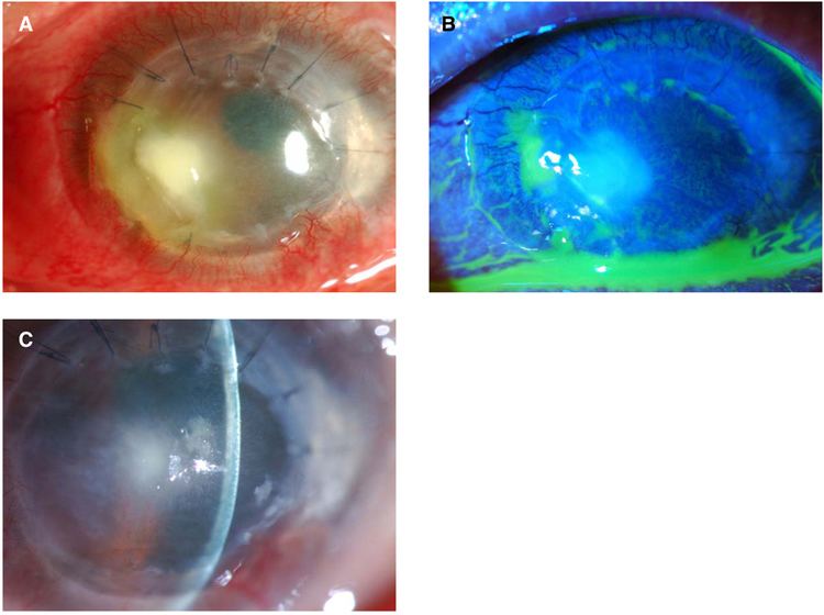 Comamonas acidovorans Experience of Comamonas Acidovorans Keratitis with Delayed Onset and