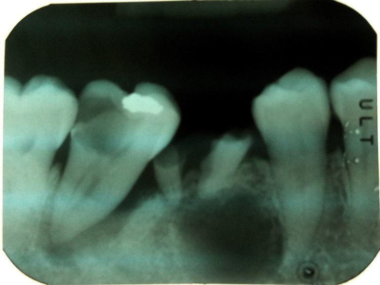 Combined periodontic-endodontic lesions