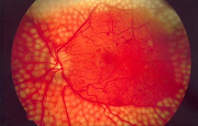 Complications of diabetes mellitus