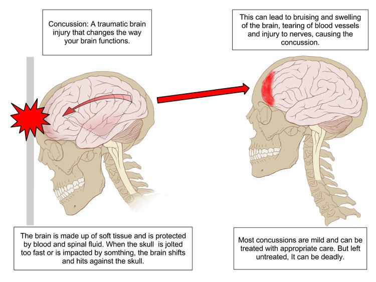 Concussions in rugby union