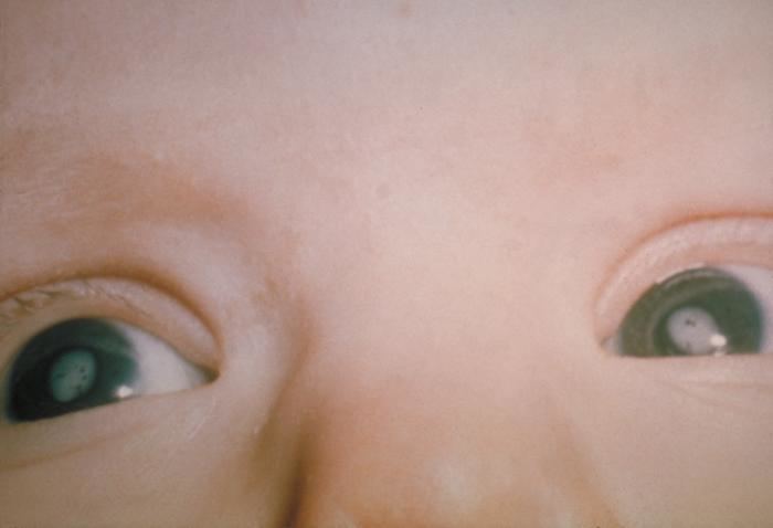 Congenital cataract