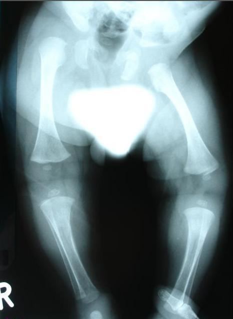 Congenital distal spinal muscular atrophy