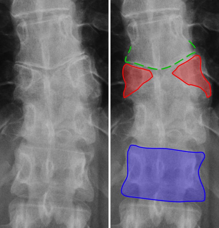 Congenital vertebral anomaly