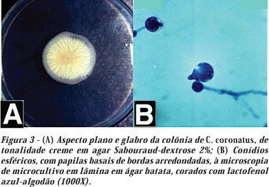 Conidiobolus coronatus Entomophthoramycosis zygomycosis caused by Conidiobolus coronatus