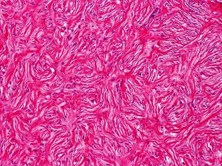 Connective tissue nevus