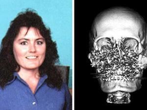 Connie Culp CONNIE CULP A LIFE OF PAIN FACE TRANSPLANT A NEW OPPORTUNITY TO