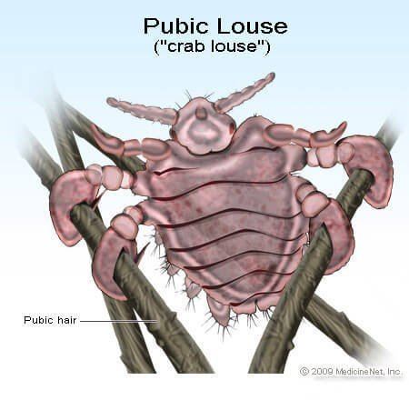 Crab louse imagesmedicinenetcomimagesillustrationspubic