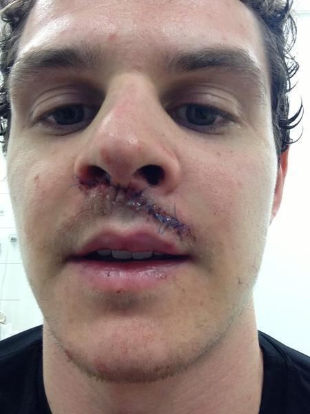 Craig Peacock Belfast Giants forward Craig Peacock took a skate to the face and