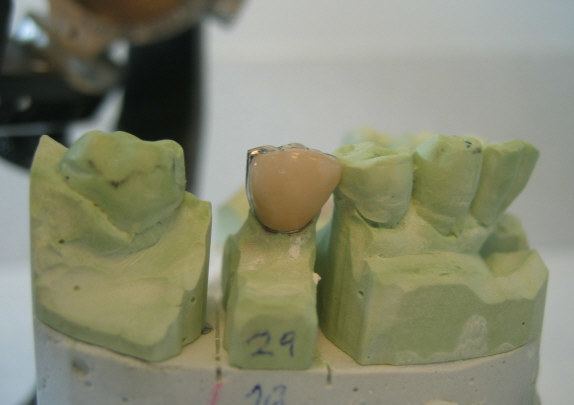 Crown (dentistry)