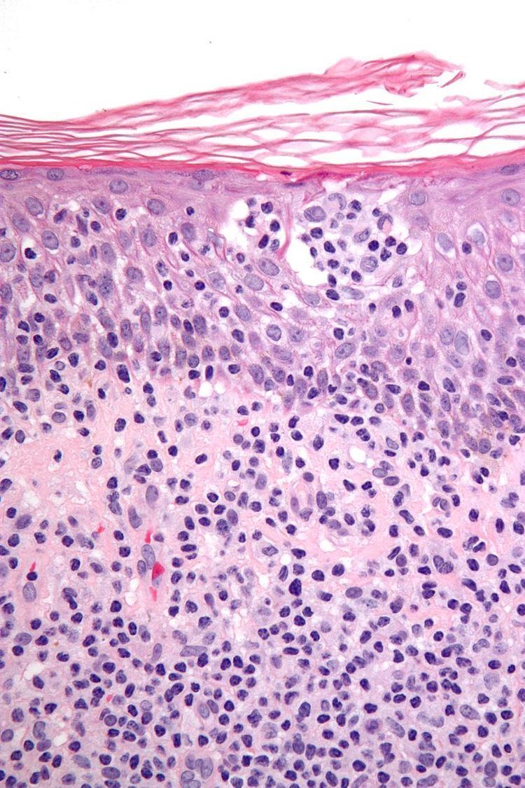 Cutaneous T cell lymphoma
