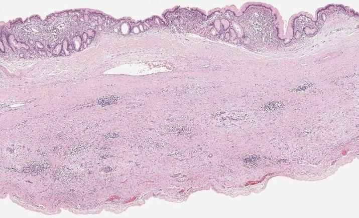 Cystic lesions of the pancreas