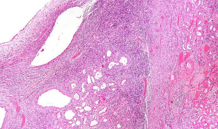 Cystic nephroma