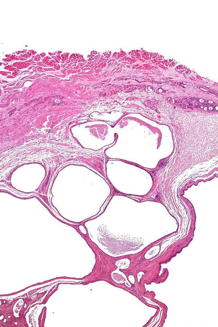 Cystic tumour of the atrioventricular nodal region
