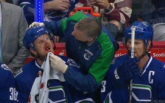 Daniel Sedin Daniel Sedins mouth is a mess after taking a puck to the face
