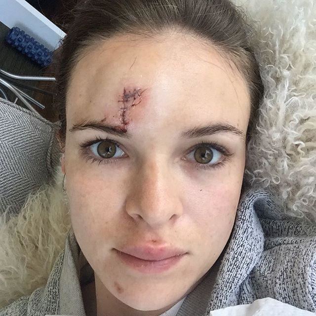 Danielle Panabaker Flash actress has fall and needs 7 stitches weeks after filming starts