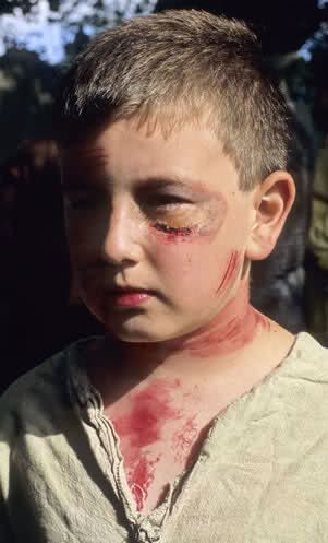 A boy with bruises and blood on his face and body while wearing light beige shirt