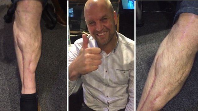 David Busst David Busst reveals astonishing scars from horror leg break against