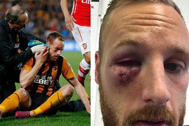 David Meyler Hull midfielder David Meyler shows extent of gruesome eye