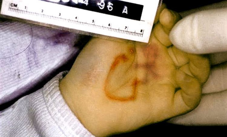 A photo showing the hand of dead JonBenét Ramsey.